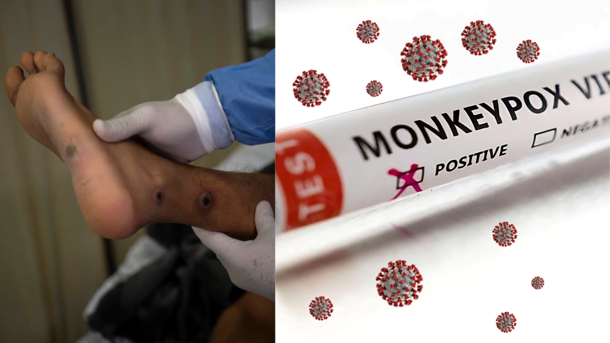 Monkey Pox (Mpox): Symptoms, Transmission, and Prevention Strategies