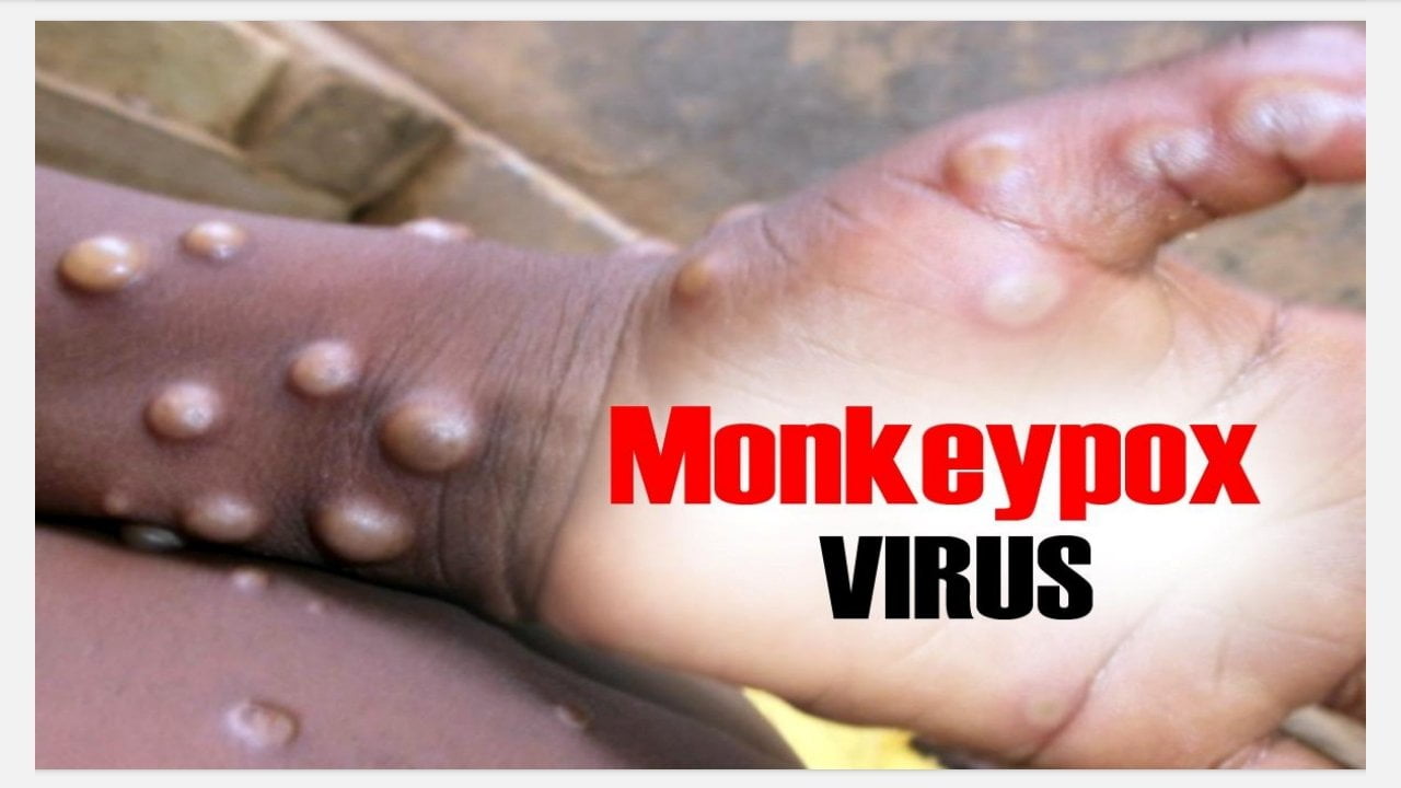 Healthcare professional in protective gear examining a patient with Mpox, featuring visible skin rash and blisters