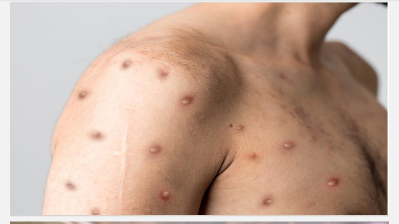 Healthcare professional in protective gear examining a patient with Mpox, featuring visible skin rash and blisters.